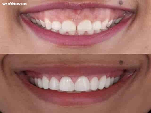 دكتورحازم البري : يشرح الإبتسامة اللثوية وطرق علاجها والتخلص منها