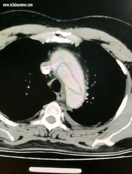 قسم جراحه القلب والصدر بجامعة أسيوط ينجح فى إجراء جراحة لإصلاح انشطار الشريان الأورطي